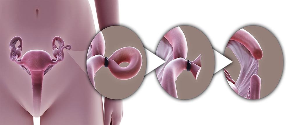 Tubal ligation in Pune step-by-step illustration of fallopian tube sterilization procedure