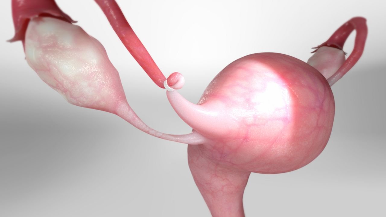 Tubal ligation in Pune illustration showing fallopian tube sterilization procedure