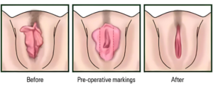 Best Hymenoplasty Doctors in Pune performing safe and confidential hymenoplasty procedures